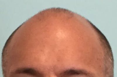 Hair Restoration for Men Before & After Gallery - Patient 318020 - Image 1