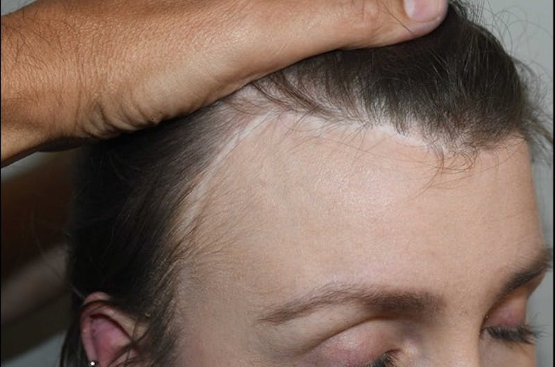 Hair Transplant Repair Before & After Gallery - Patient 127609 - Image 3
