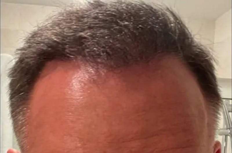 Hair Restoration for Men Before & After Gallery - Patient 118979 - Image 2
