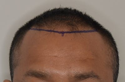 Hair Restoration for Men Before & After Gallery - Patient 326622 - Image 1
