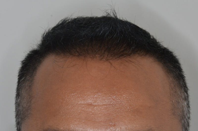 Hair Restoration for Men Before & After Gallery - Patient 366786 - Image 2
