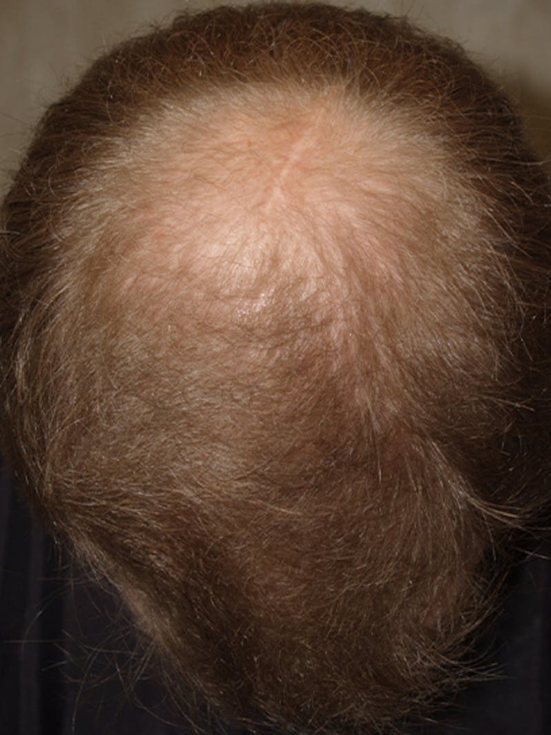 Hair Restoration for Men Before & After Gallery - Patient 270028 - Image 1