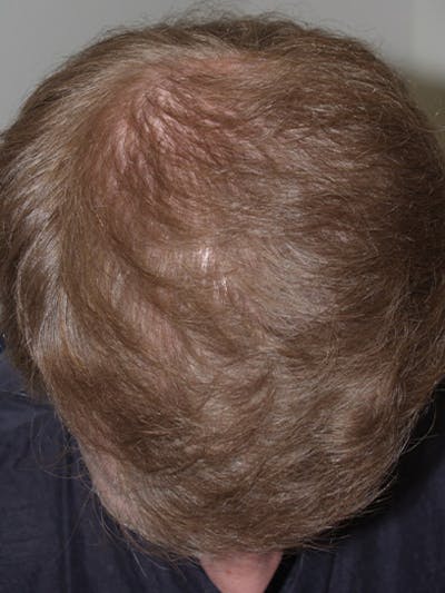 Hair Restoration for Men Before & After Gallery - Patient 114310 - Image 2