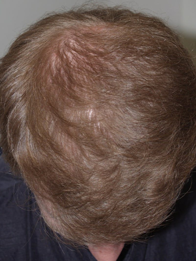 Hair Restoration for Men Before & After Gallery - Patient 270028 - Image 2