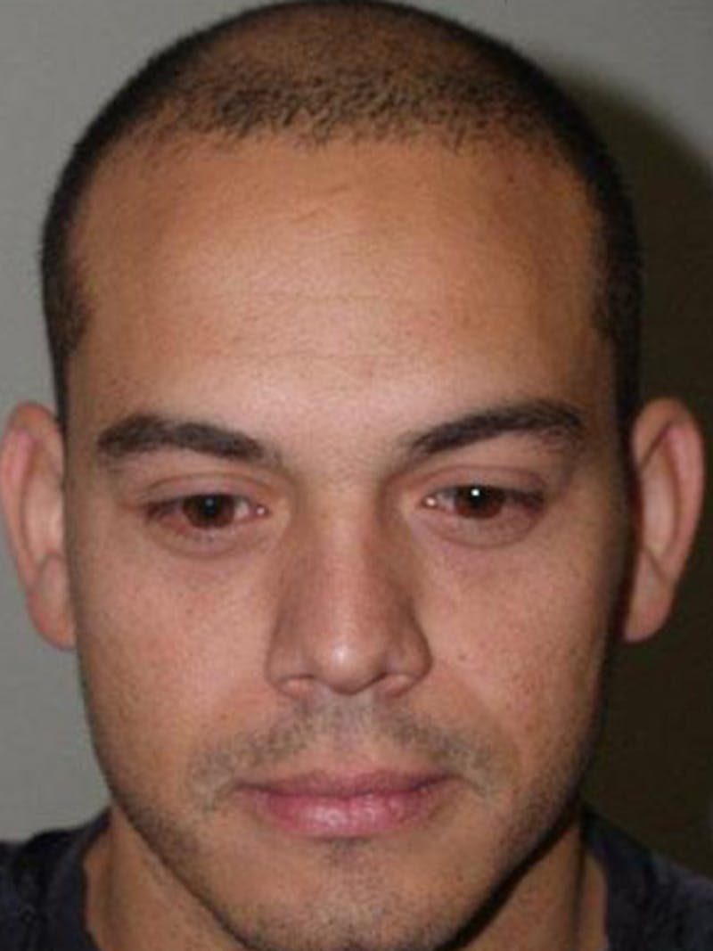 Hair Restoration for Men Before & After Gallery - Patient 156145 - Image 1