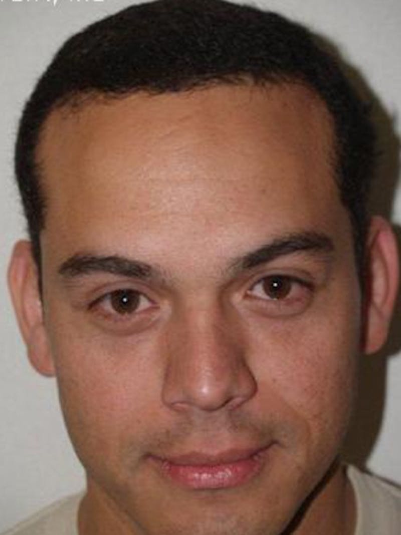 Hair Restoration for Men Before & After Gallery - Patient 156145 - Image 2
