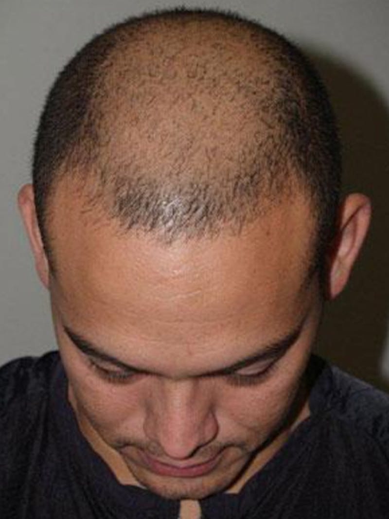 Hair Restoration for Men Before & After Gallery - Patient 156145 - Image 3