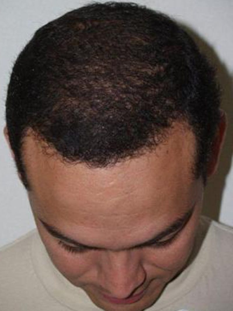 Hair Restoration for Men Before & After Gallery - Patient 156145 - Image 4
