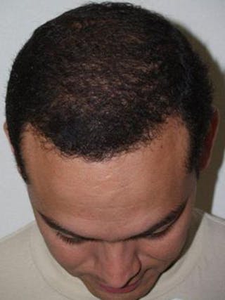 Hair Restoration for Men Before & After Gallery - Patient 178020 - Image 4