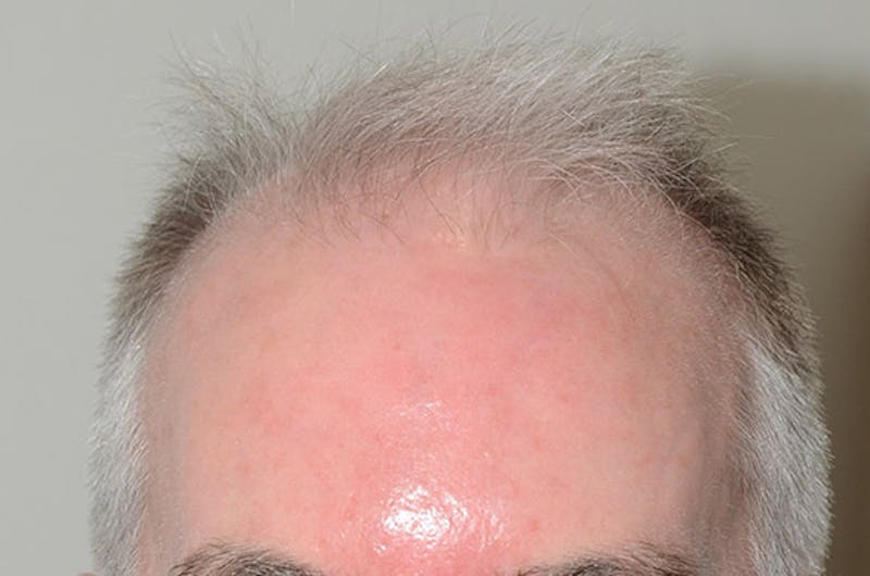 Hair Restoration for Men Before & After Gallery - Patient 149845 - Image 1
