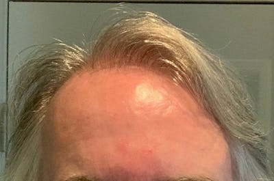 Hair Restoration for Men Before & After Gallery - Patient 224217 - Image 2