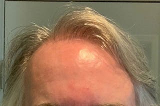 Hair Restoration for Men Before & After Gallery - Patient 149845 - Image 2