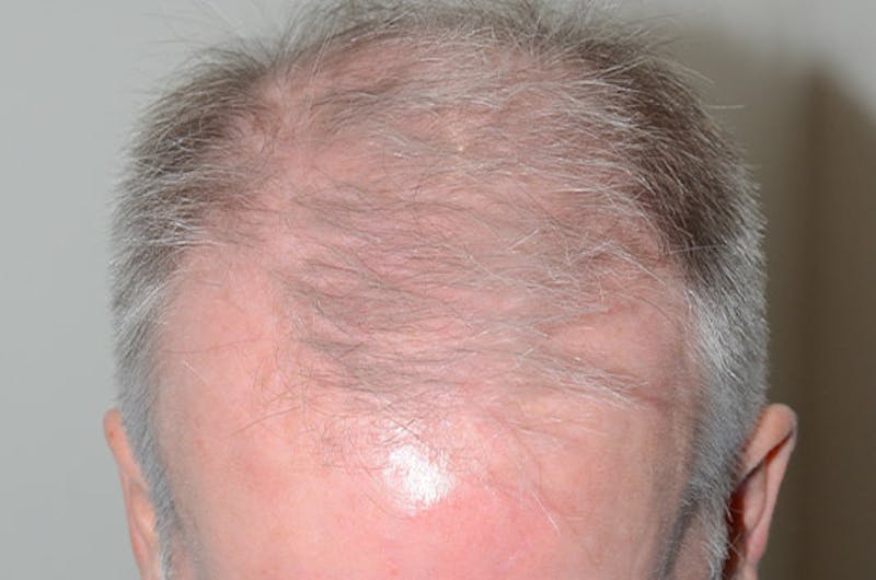 Hair Restoration for Men Before & After Gallery - Patient 149845 - Image 3