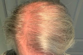 Hair Restoration for Men Before & After Gallery - Patient 149845 - Image 4