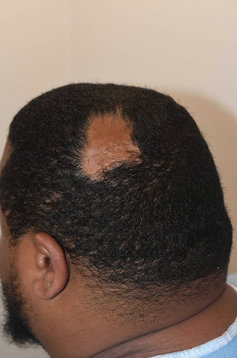Hair Restoration for Men Before & After Gallery - Patient 893701 - Image 1