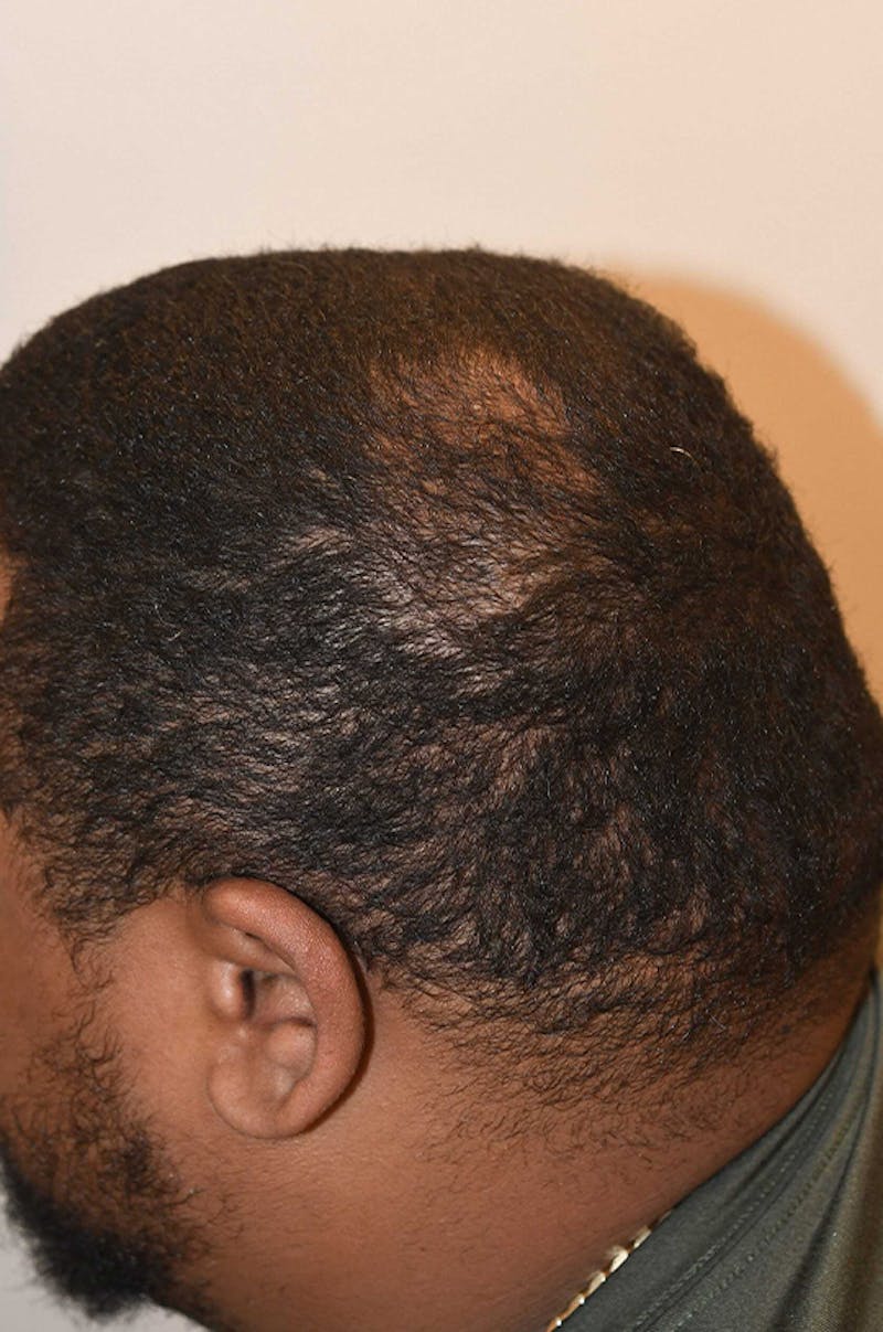 Hair Restoration for Men Before & After Gallery - Patient 893701 - Image 2