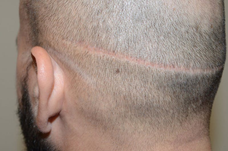 Hair Transplant Repair Before & After Gallery - Patient 137153 - Image 3