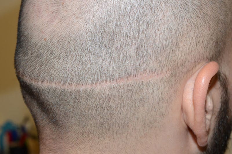 Hair Transplant Repair Before & After Gallery - Patient 137153 - Image 5