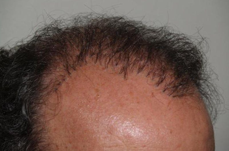 Hair Restoration for Men Before & After Gallery - Patient 181142 - Image 1