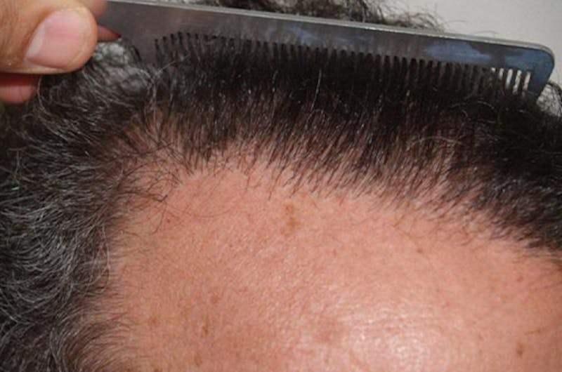 Hair Restoration for Men Before & After Gallery - Patient 181142 - Image 2