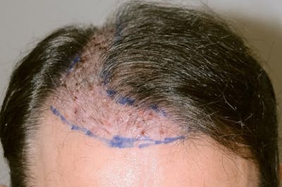Hair Transplant Repair Before & After Gallery - Patient 155815 - Image 1
