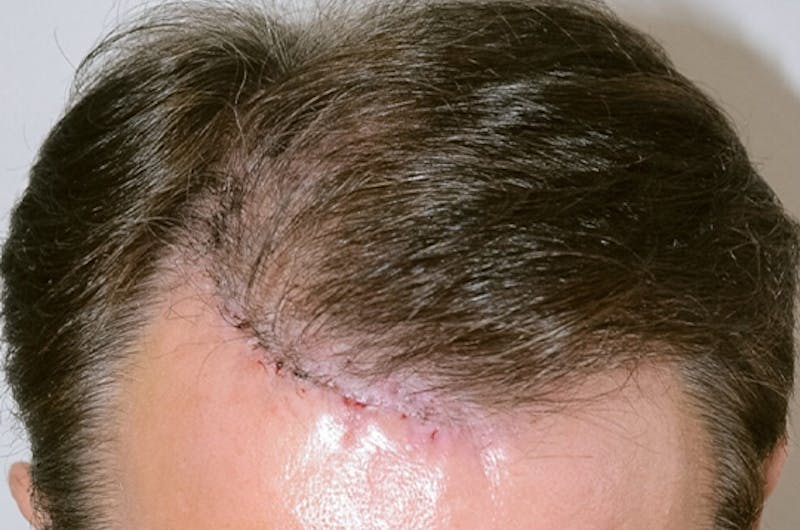 Hair Restoration for Men Before & After Gallery - Patient 335365 - Image 2