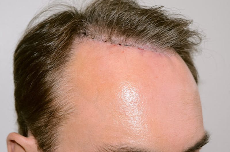 Hair Restoration for Men Before & After Gallery - Patient 335365 - Image 4