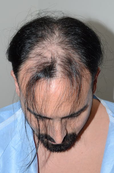 Hair Restoration for Men Before & After Gallery - Patient 301468 - Image 1