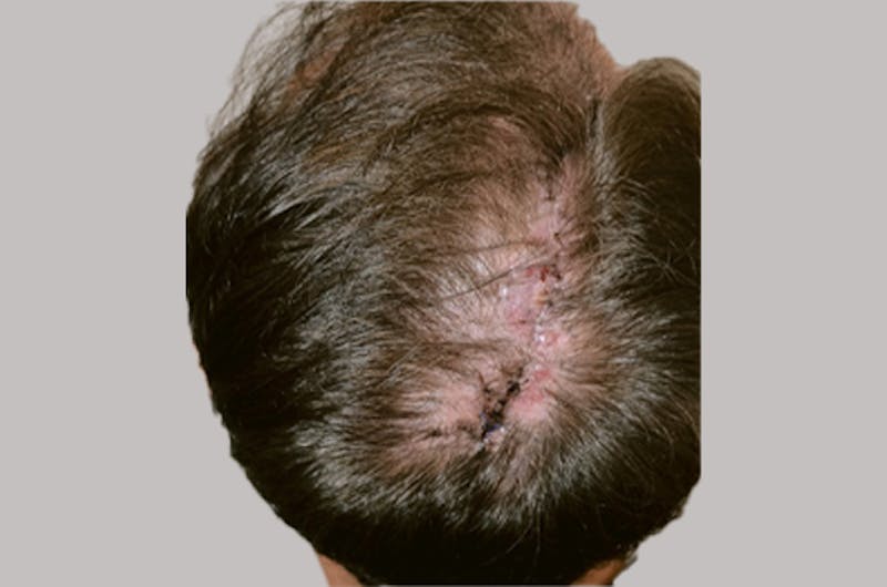 Hair Restoration for Men Before & After Gallery - Patient 335365 - Image 6
