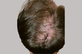 Hair Restoration for Men Before & After Gallery - Patient 237260 - Image 6