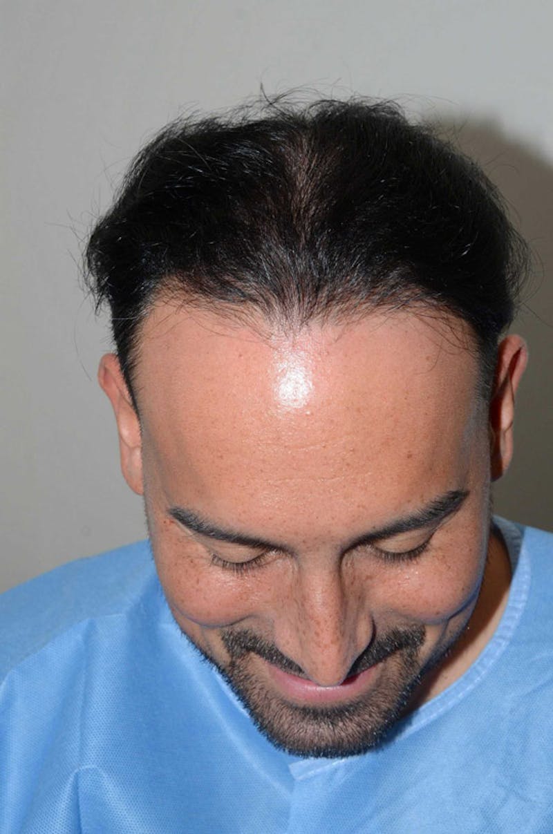 Hair Restoration for Men Before & After Gallery - Patient 947480 - Image 2