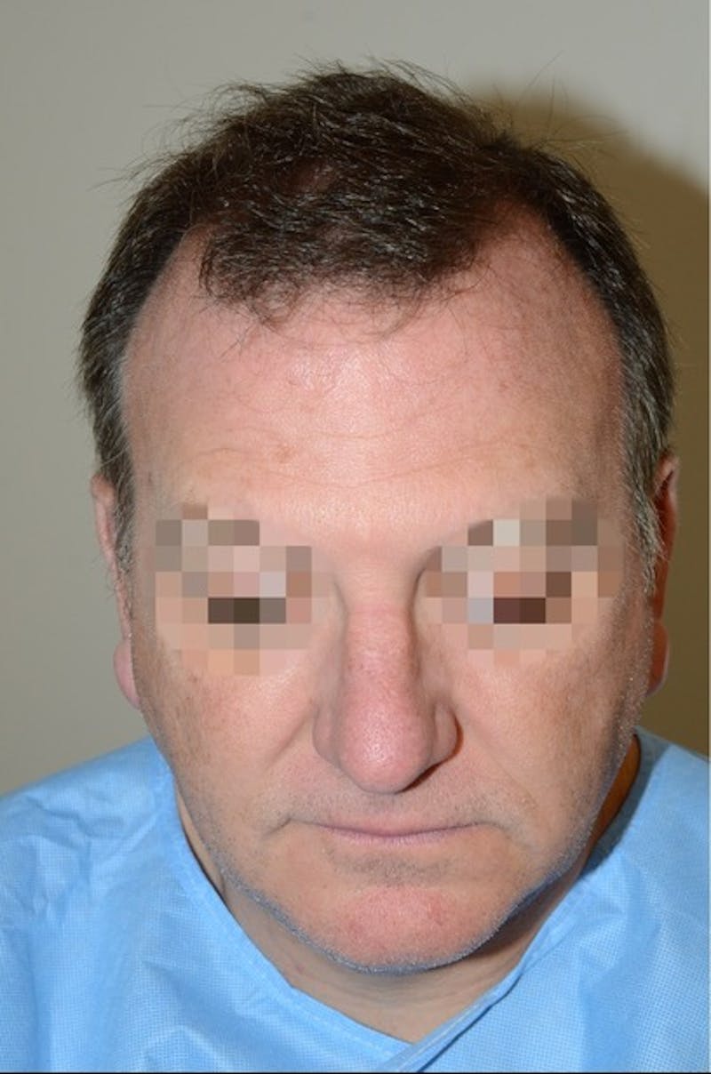Hair Transplant Repair Before & After Gallery - Patient 835302 - Image 1