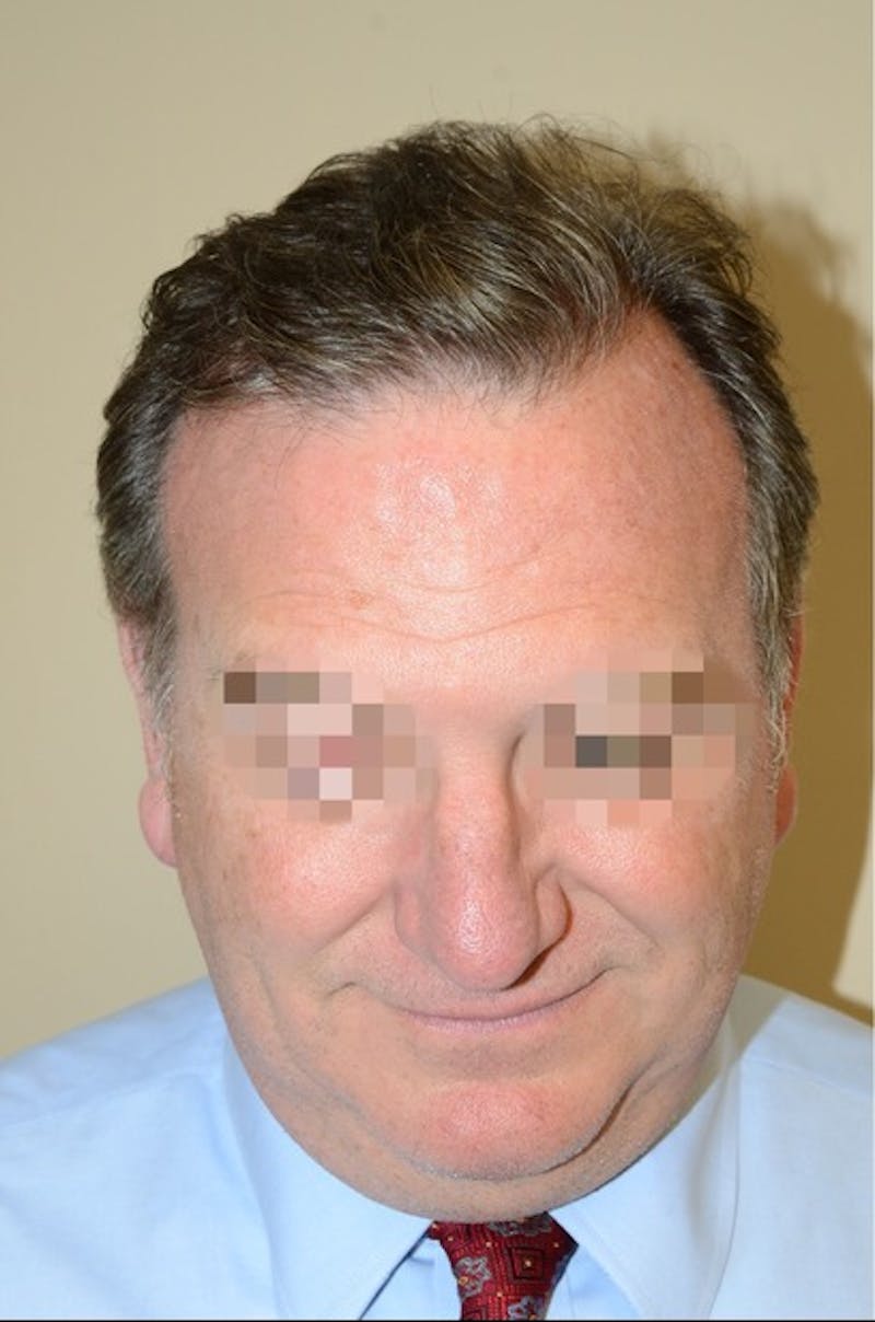 Hair Transplant Repair Before & After Gallery - Patient 835302 - Image 2