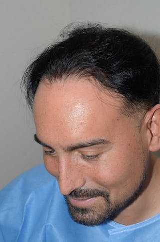 Hair Restoration for Men Before & After Gallery - Patient 212650 - Image 4