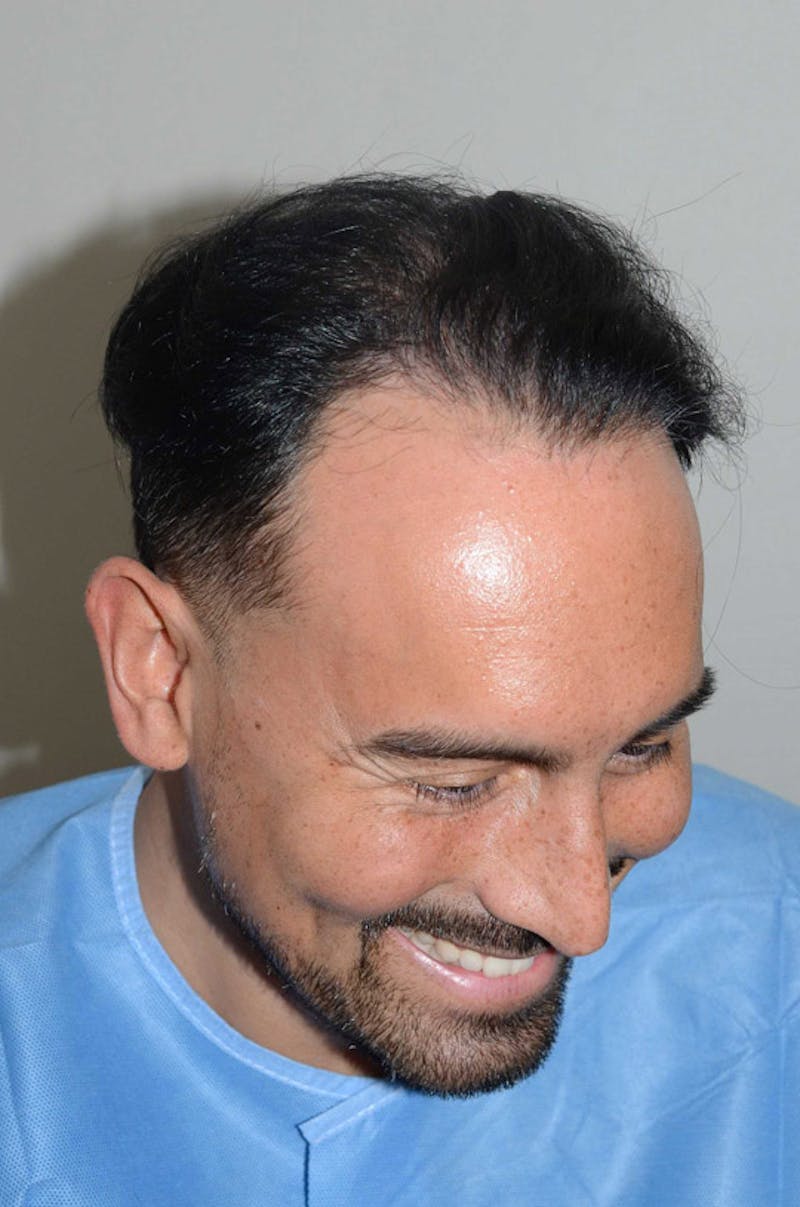 Hair Restoration for Men Before & After Gallery - Patient 947480 - Image 6