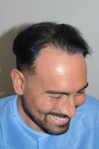 Hair Restoration for Men Before & After Gallery - Patient 212650 - Image 6