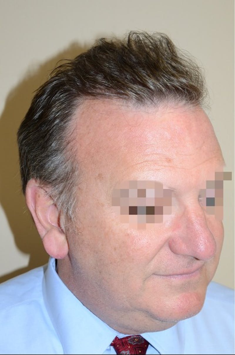 Hair Transplant Repair Before & After Gallery - Patient 835302 - Image 6