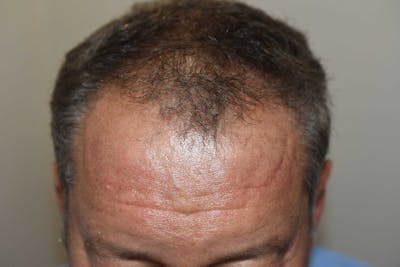 Hair Restoration for Men Before & After Gallery - Patient 216716 - Image 1