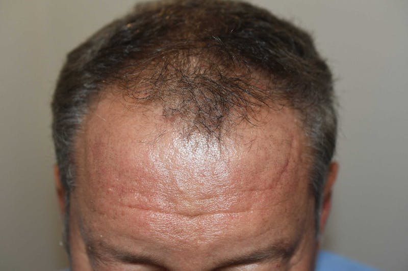Hair Restoration for Men Before & After Gallery - Patient 336145 - Image 1