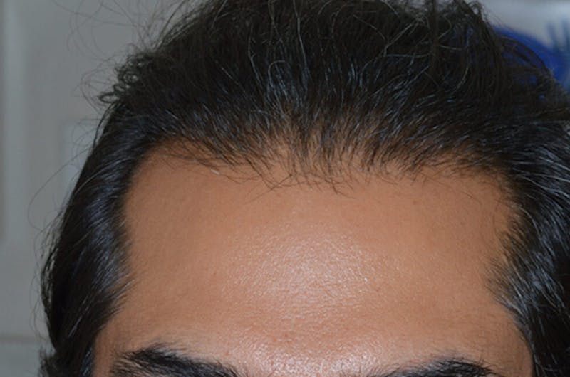 Hair Restoration for Men Before & After Gallery - Patient 374428 - Image 2