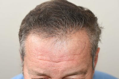 Hair Restoration for Men Before & After Gallery - Patient 216716 - Image 2