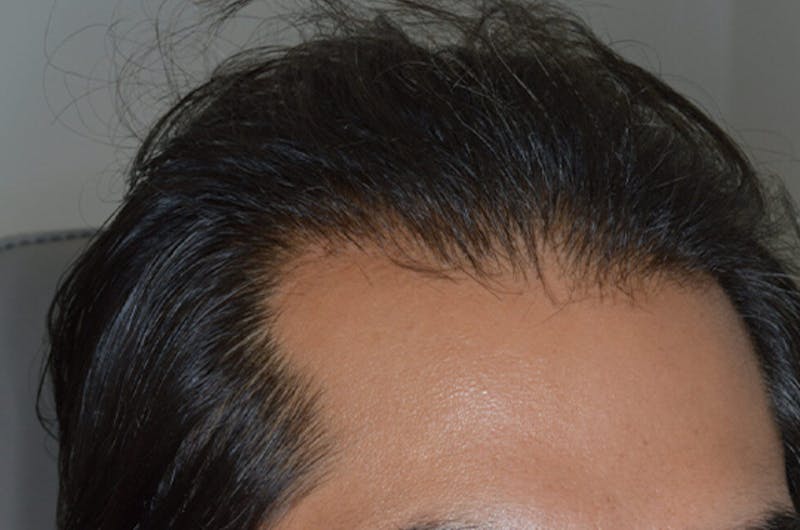 Hair Restoration for Men Before & After Gallery - Patient 374428 - Image 4