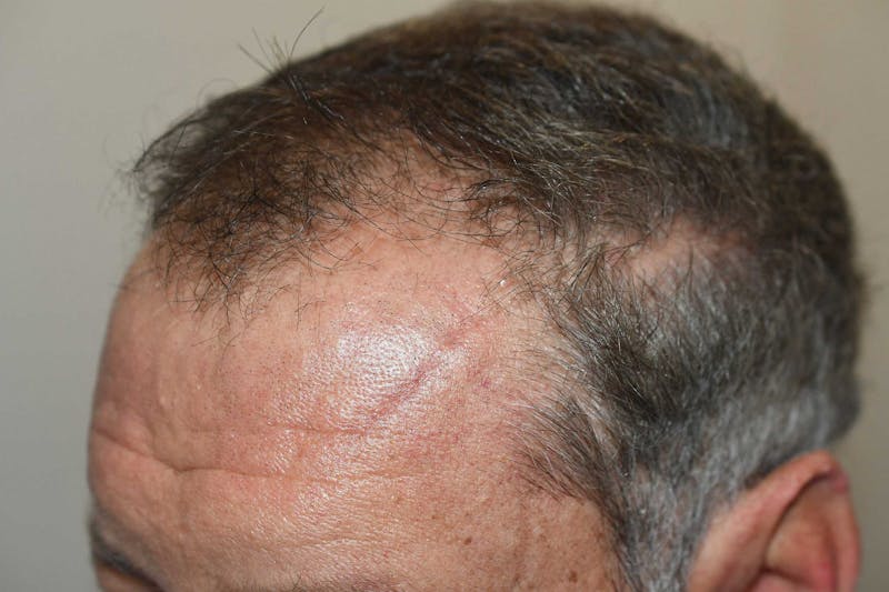Hair Restoration for Men Before & After Gallery - Patient 368593 - Image 3