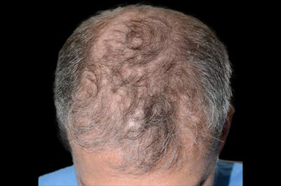 Hair Restoration for Men Before & After Gallery - Patient 407989 - Image 1