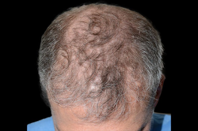 Hair Restoration for Men Before & After Gallery - Patient 338340 - Image 1