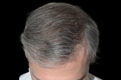 Hair Restoration for Men Before & After Gallery - Patient 407989 - Image 2