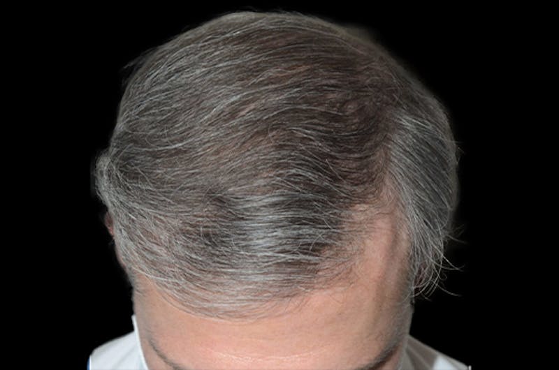 Hair Restoration for Men Before & After Gallery - Patient 338340 - Image 2