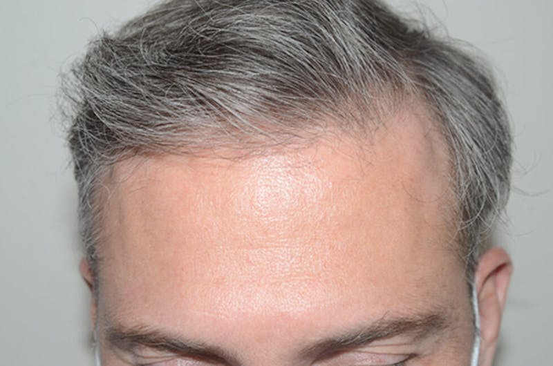 Hair Restoration for Men Before & After Gallery - Patient 338340 - Image 4