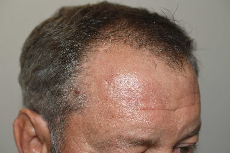 Hair Restoration for Men Before & After Gallery - Patient 368593 - Image 5