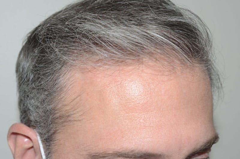 Hair Restoration for Men Before & After Gallery - Patient 338340 - Image 6